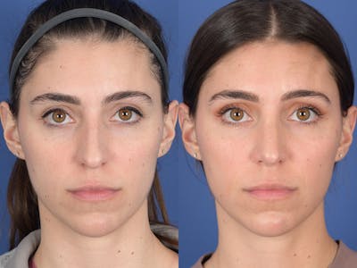 Rhinoplasty Before & After Gallery - Patient 726862 - Image 1