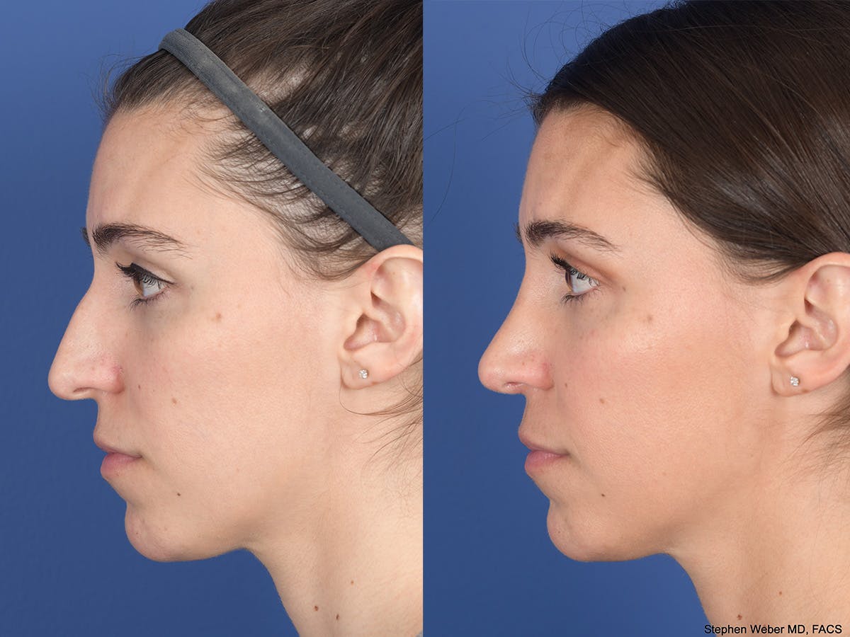 Rhinoplasty Before & After Gallery - Patient 726862 - Image 2