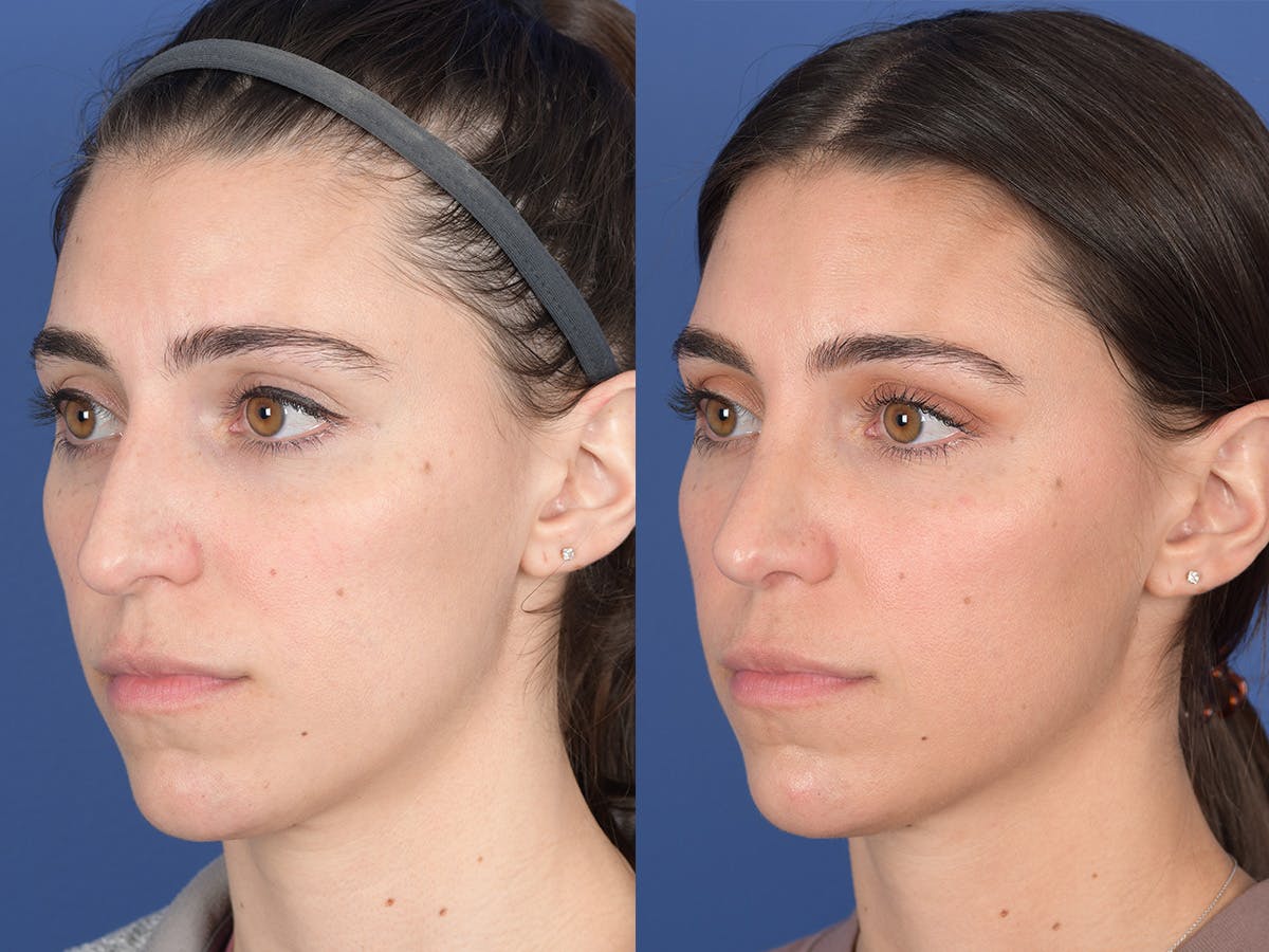 Rhinoplasty Before & After Gallery - Patient 726862 - Image 3