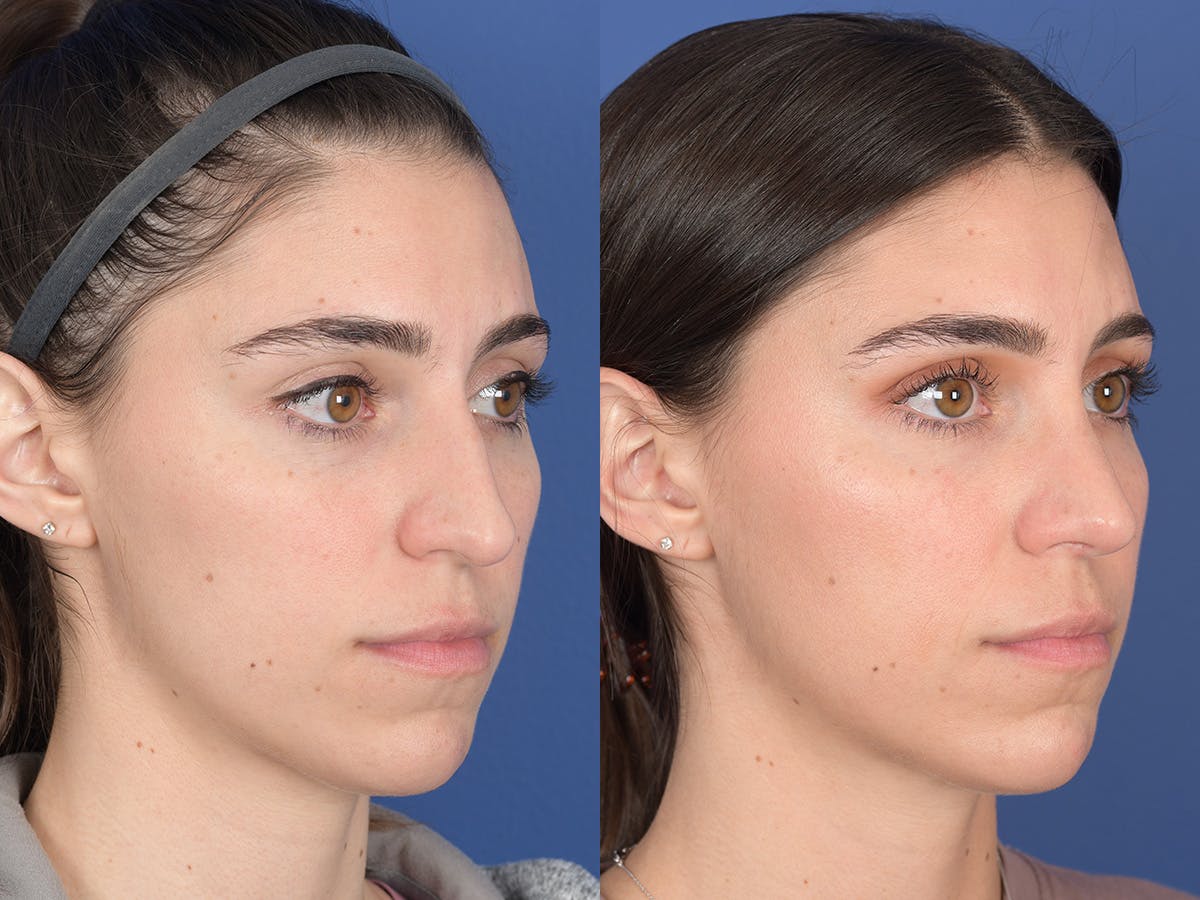 Rhinoplasty Before & After Gallery - Patient 726862 - Image 4