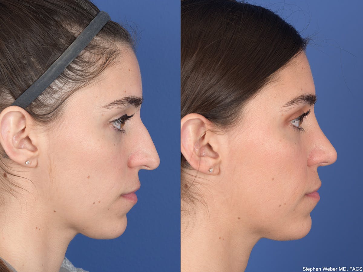 Rhinoplasty Before & After Gallery - Patient 726862 - Image 5