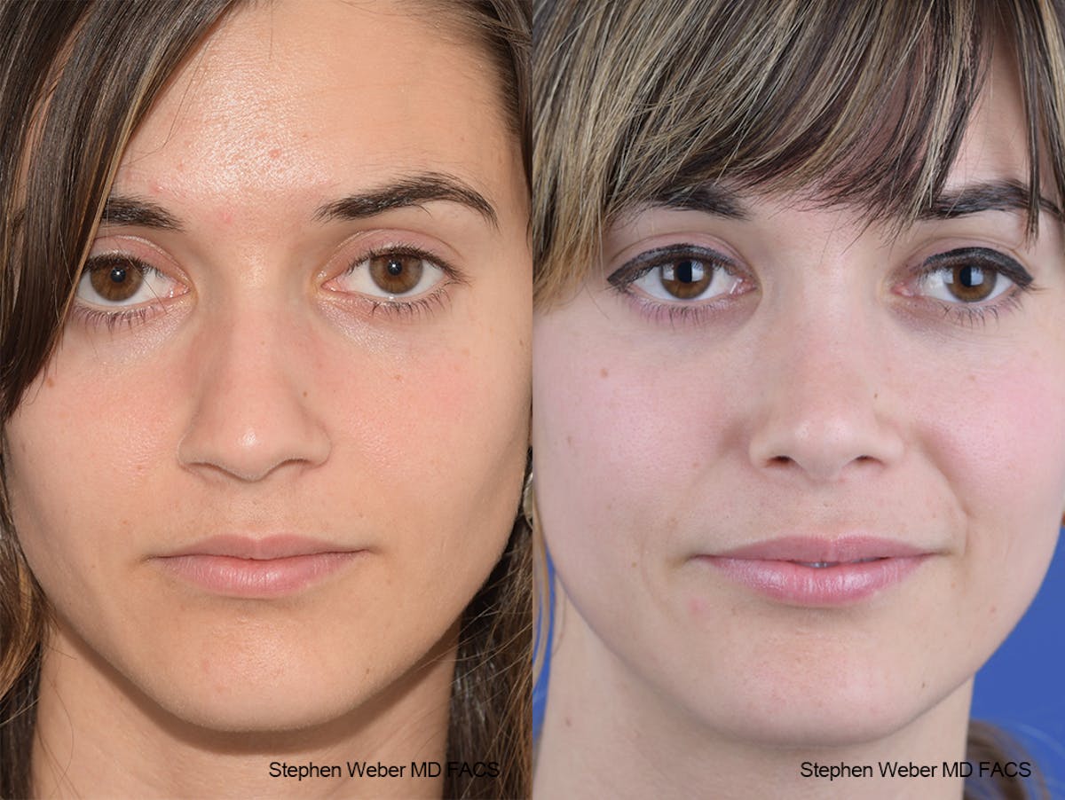 Rhinoplasty Before & After Gallery - Patient 230682 - Image 1