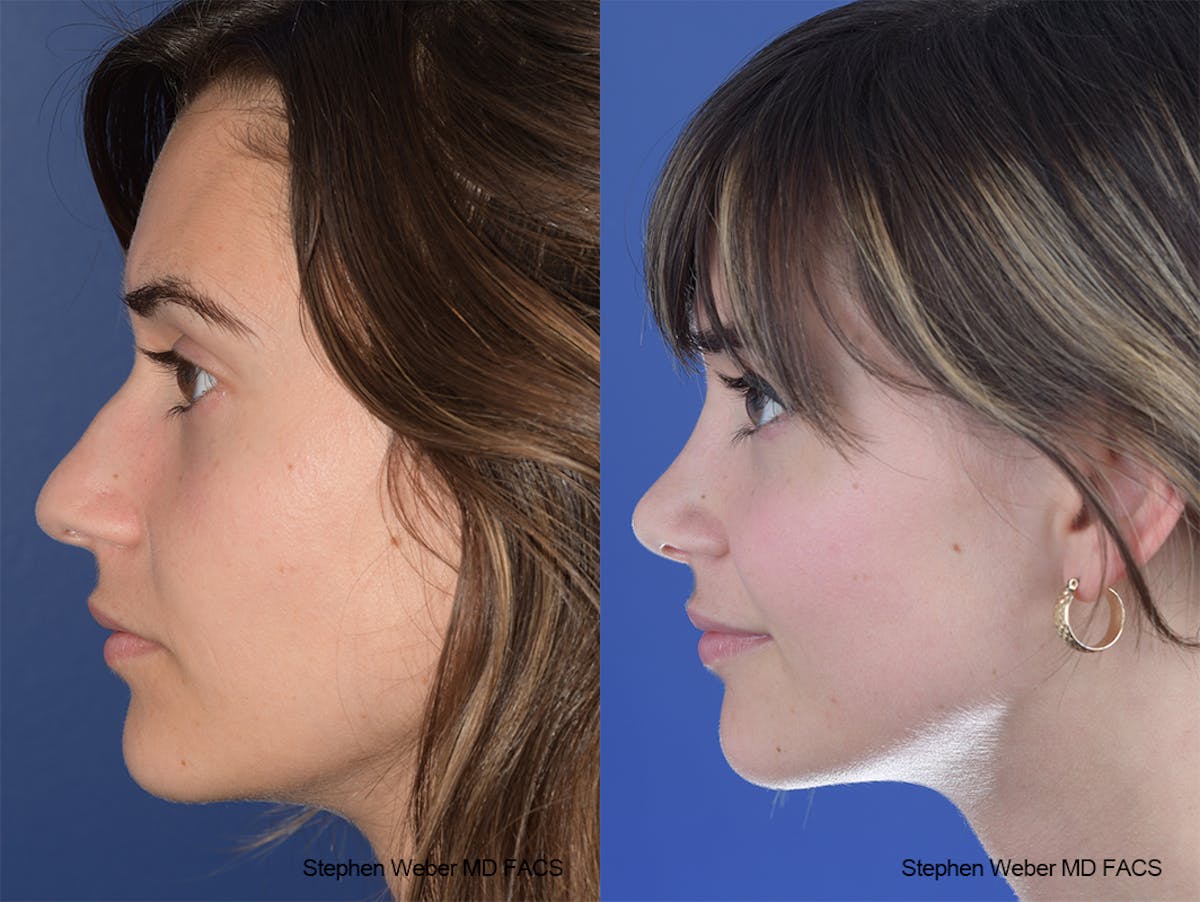 Rhinoplasty Before & After Gallery - Patient 230682 - Image 2
