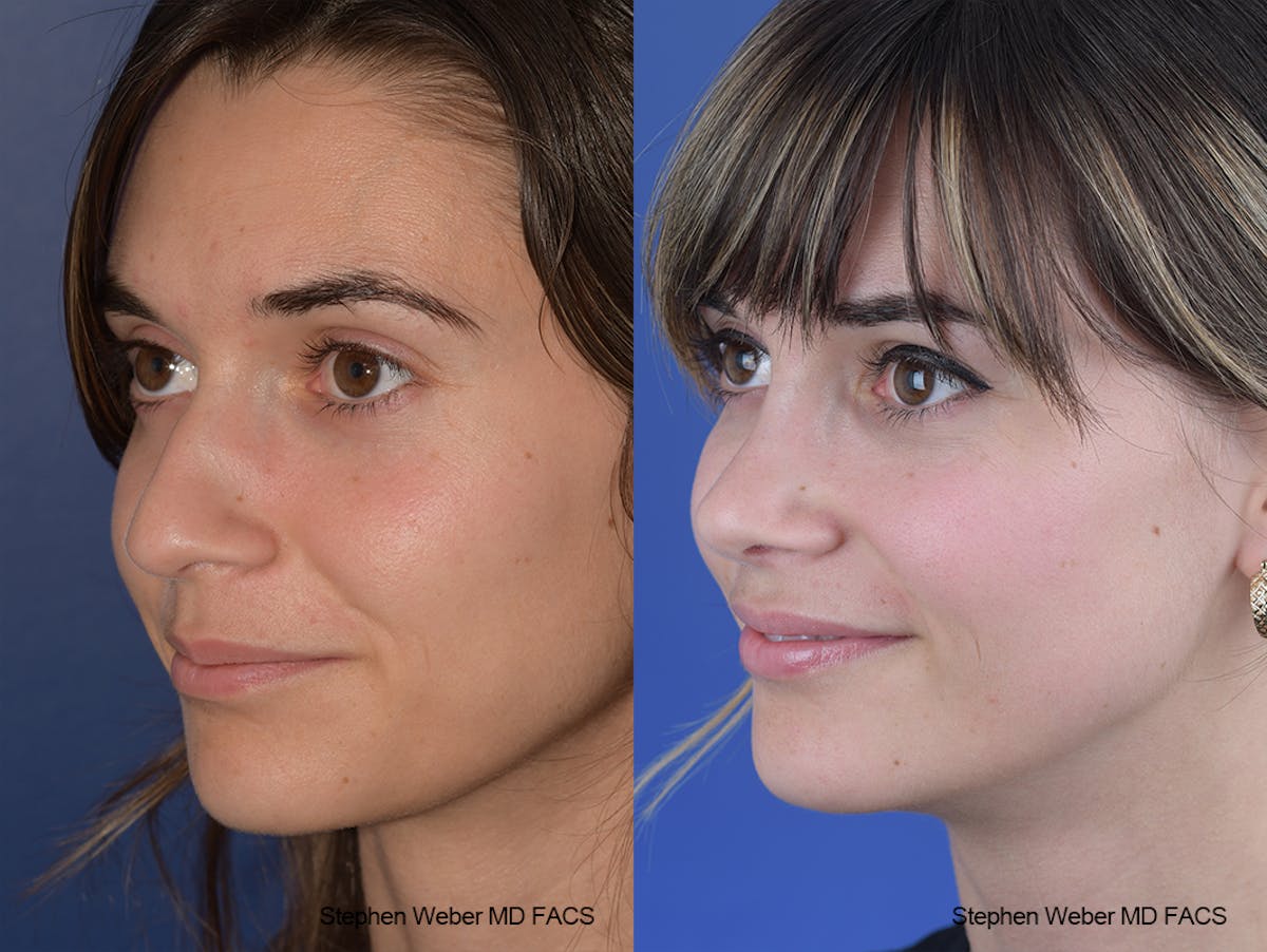 Rhinoplasty Before & After Gallery - Patient 230682 - Image 3