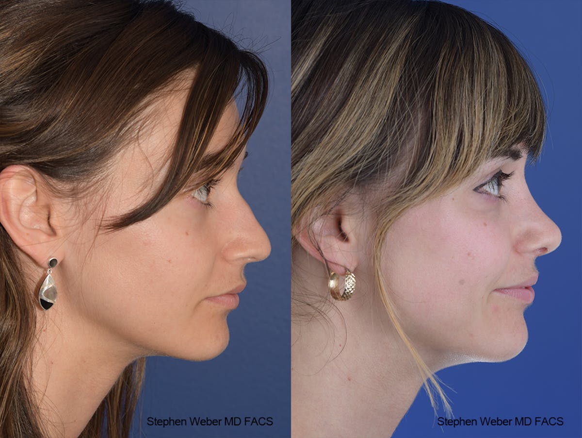 Rhinoplasty Before & After Gallery - Patient 230682 - Image 4