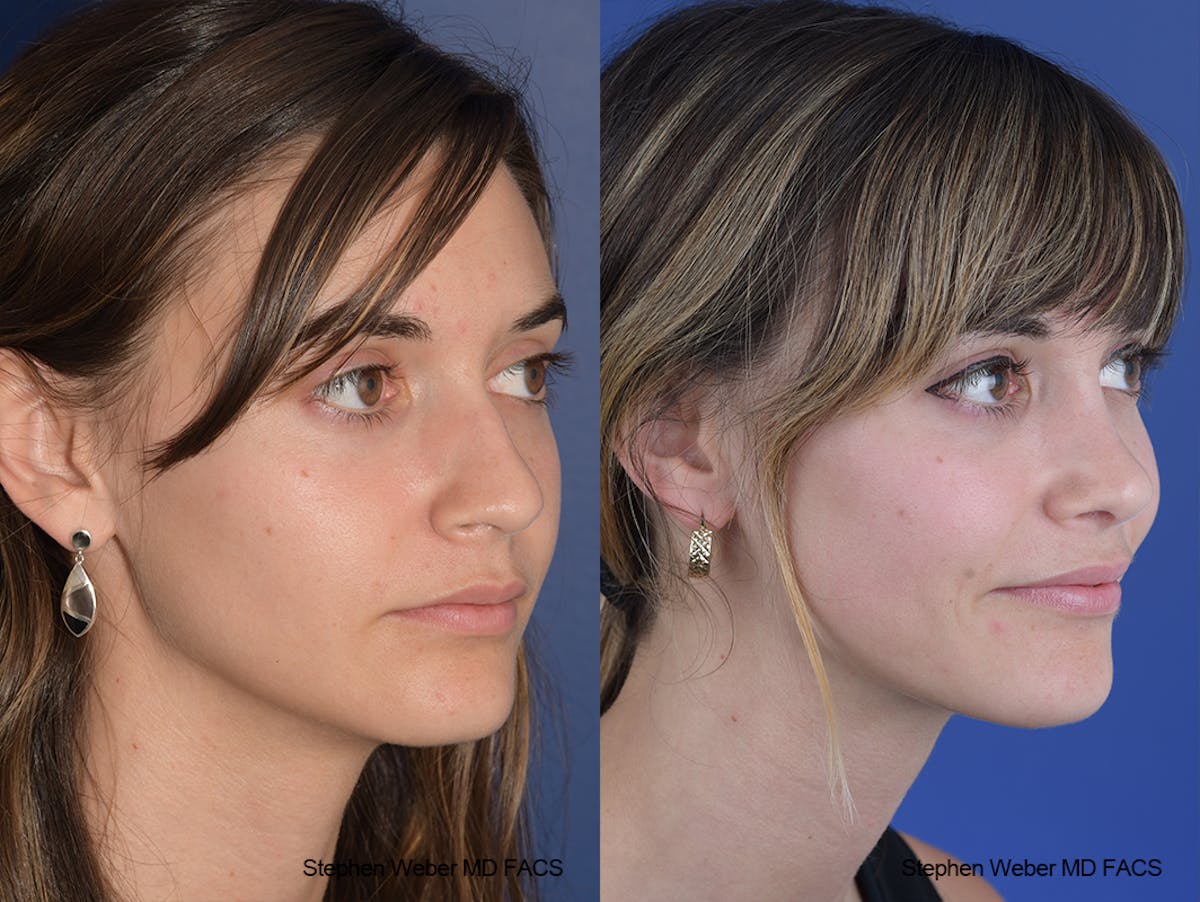 Rhinoplasty Before & After Gallery - Patient 230682 - Image 5
