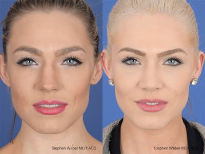 Rhinoplasty Before & After Gallery - Patient 189156 - Image 1