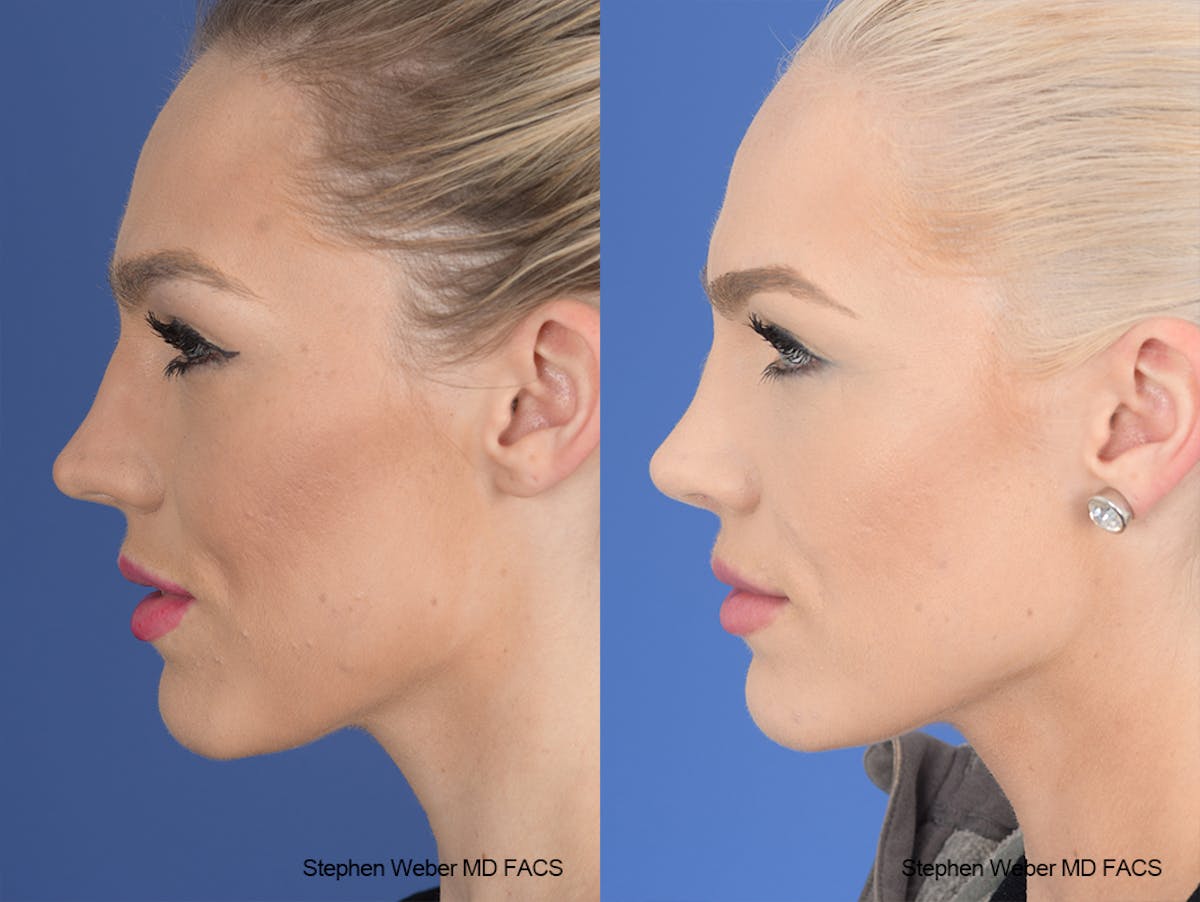 Rhinoplasty Before & After Gallery - Patient 189156 - Image 2