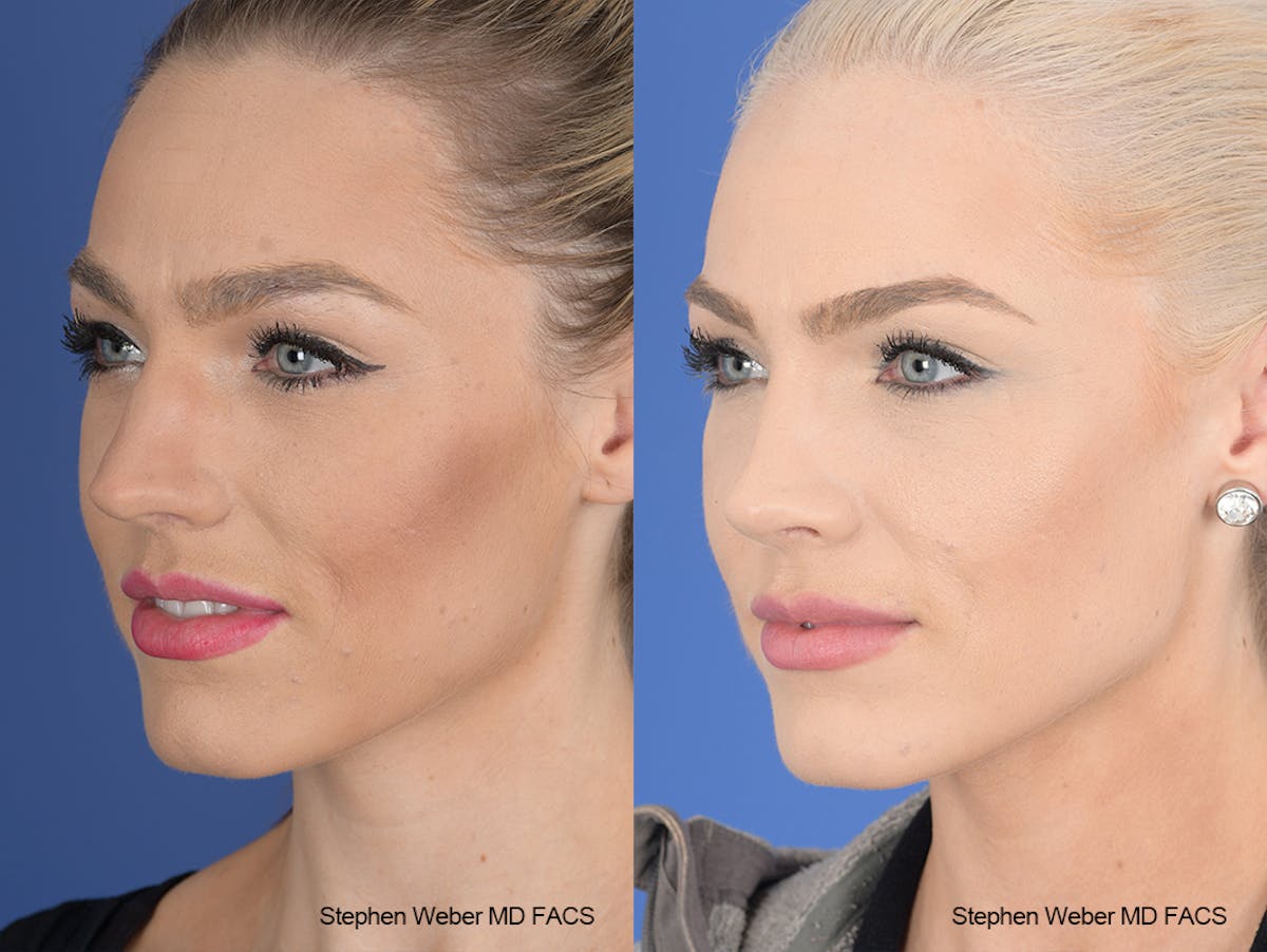 Rhinoplasty Before & After Gallery - Patient 189156 - Image 3