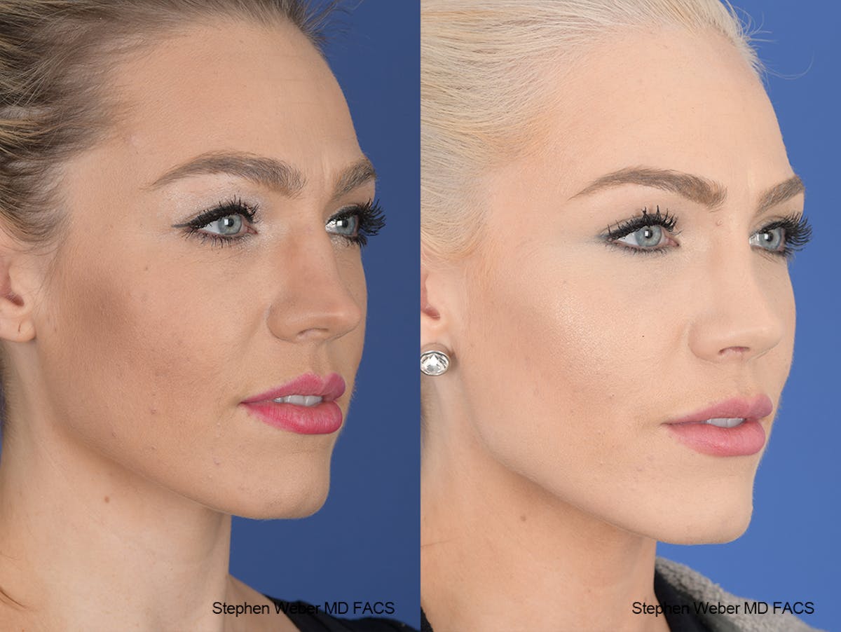 Rhinoplasty Before & After Gallery - Patient 189156 - Image 5