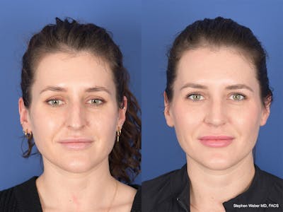 Rhinoplasty Before & After Gallery - Patient 345714 - Image 1