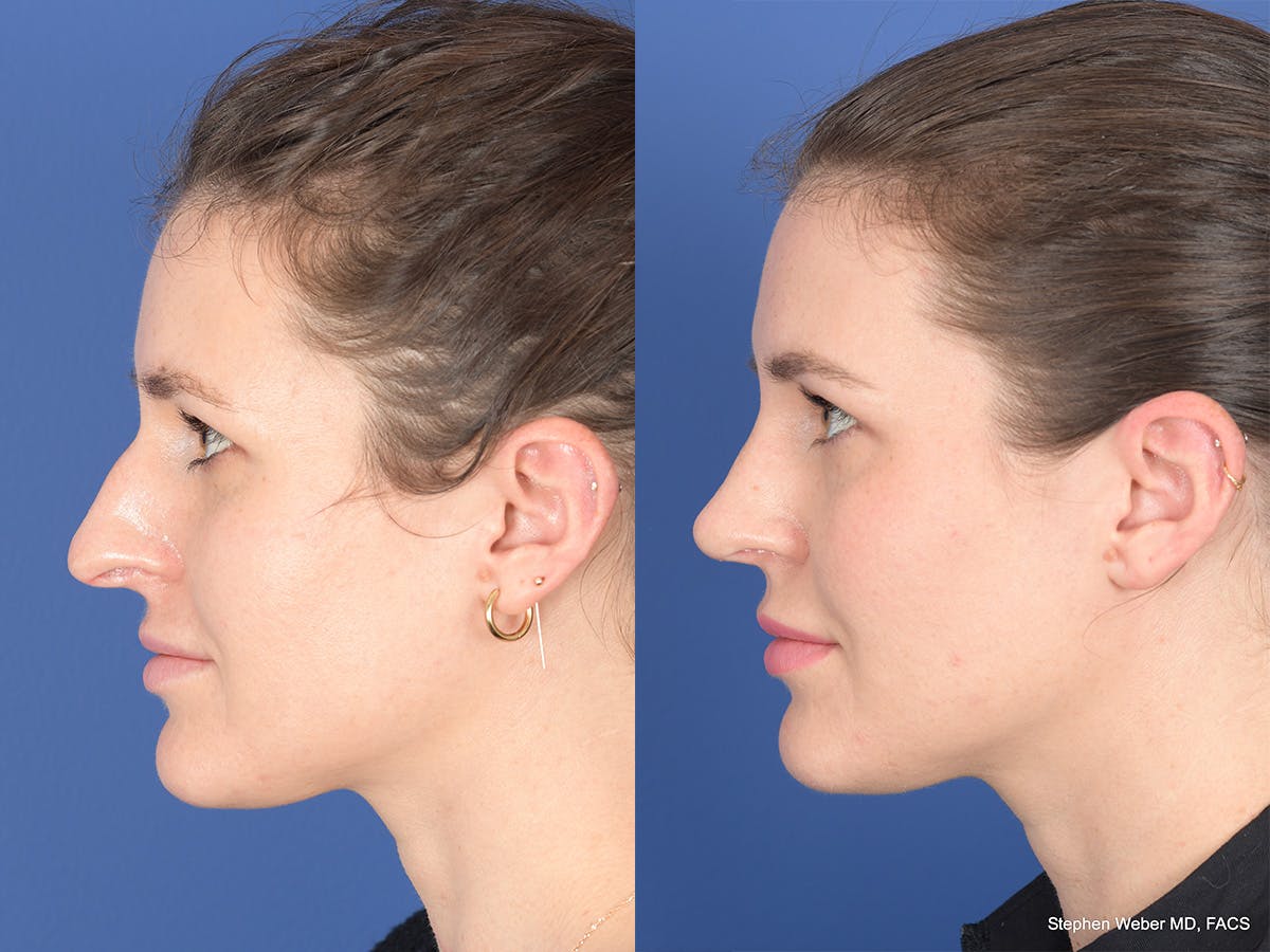 Rhinoplasty Before & After Gallery - Patient 345714 - Image 2