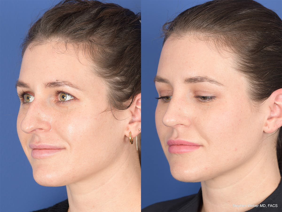 Rhinoplasty Before & After Gallery - Patient 345714 - Image 3