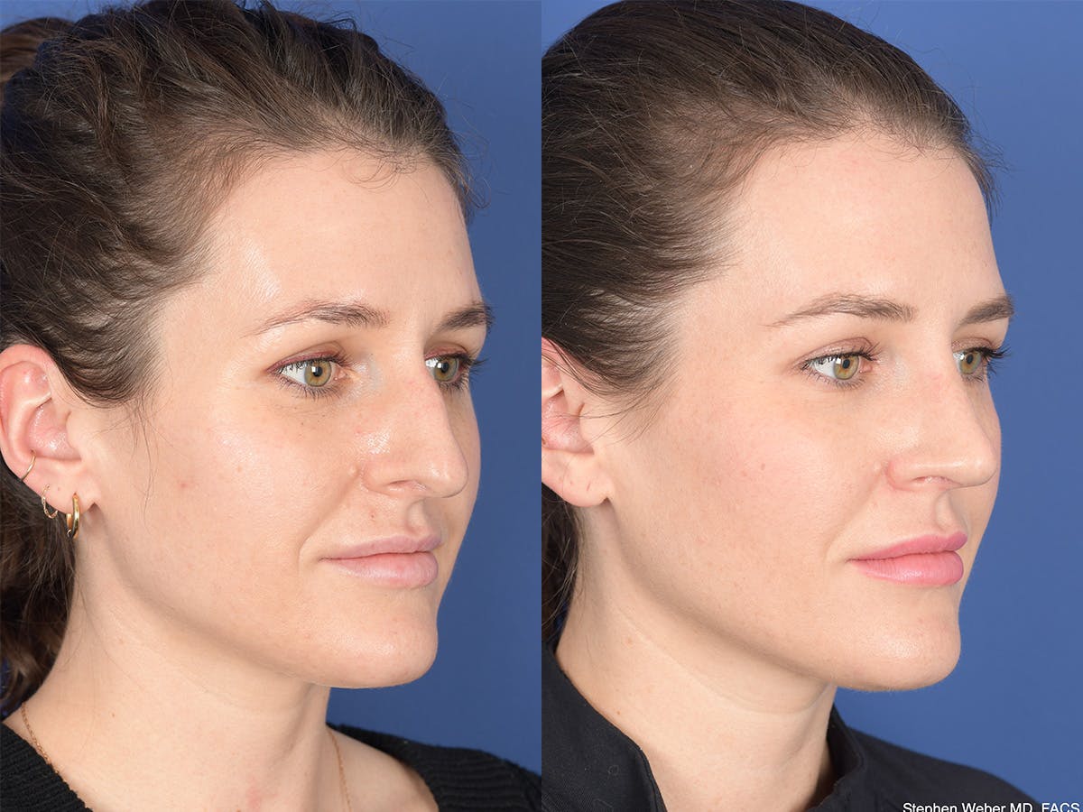 Rhinoplasty Before & After Gallery - Patient 345714 - Image 4