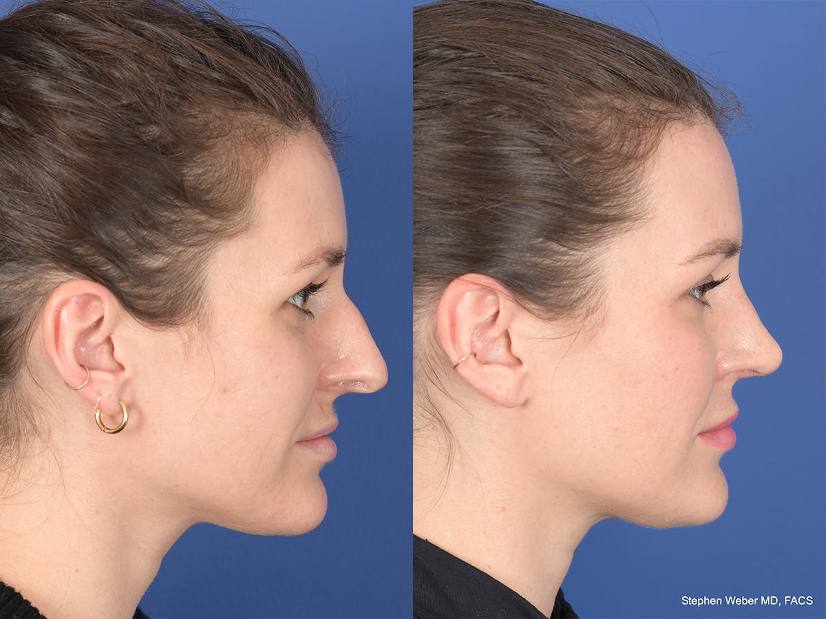 Rhinoplasty Before & After Gallery - Patient 345714 - Image 5