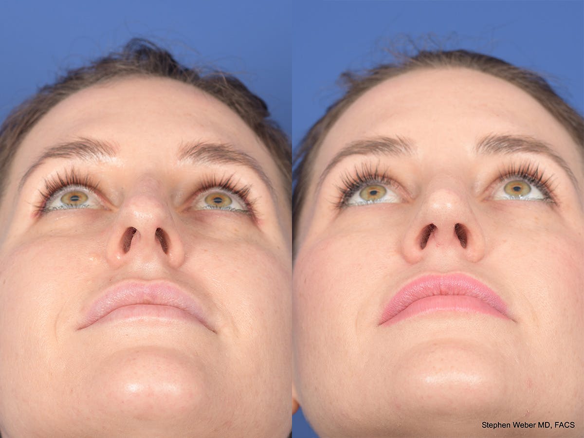 Rhinoplasty Before & After Gallery - Patient 345714 - Image 6