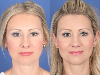 Rhinoplasty Before & After Gallery - Patient 320839 - Image 1