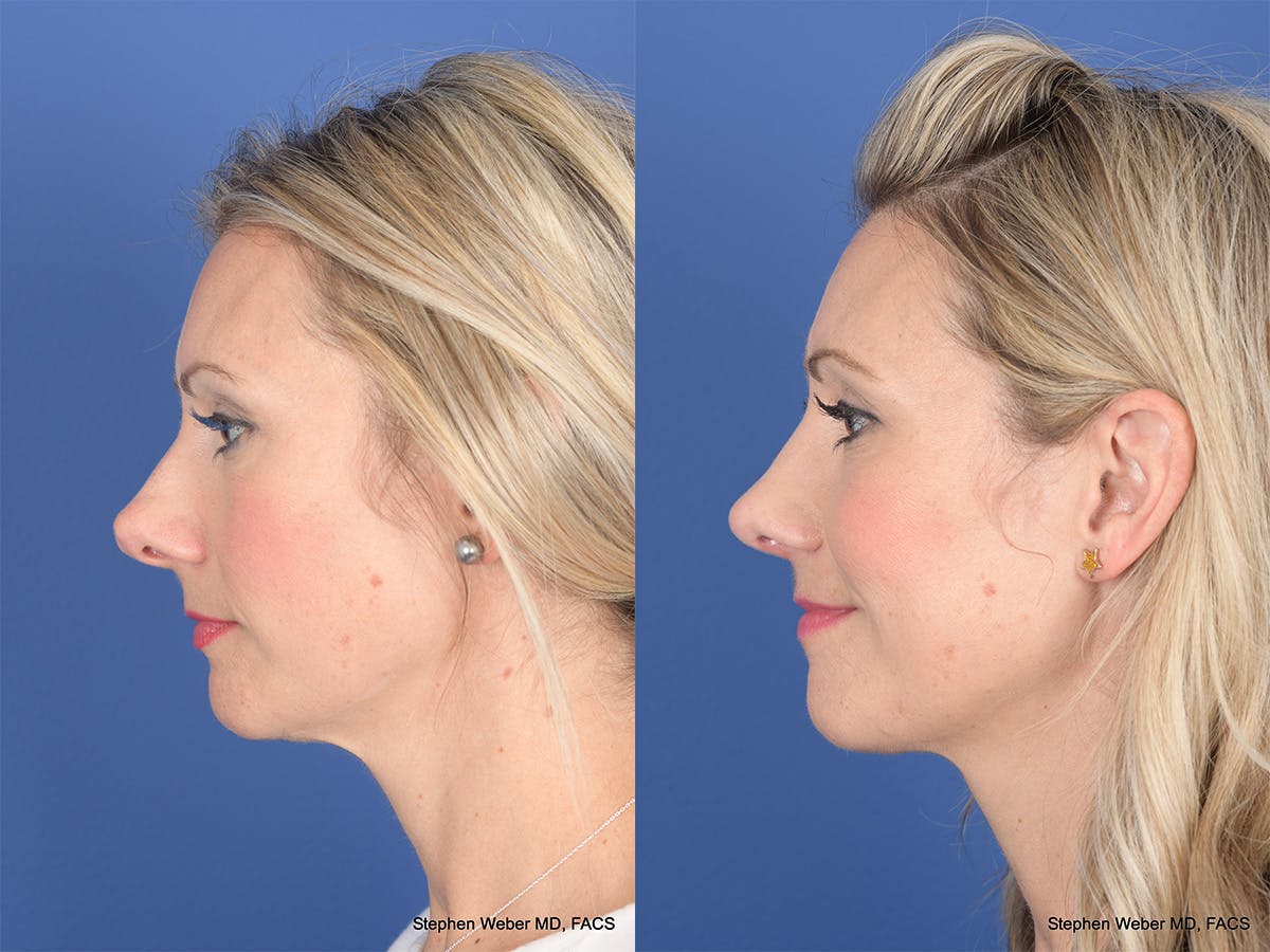 Rhinoplasty Before & After Gallery - Patient 320839 - Image 2