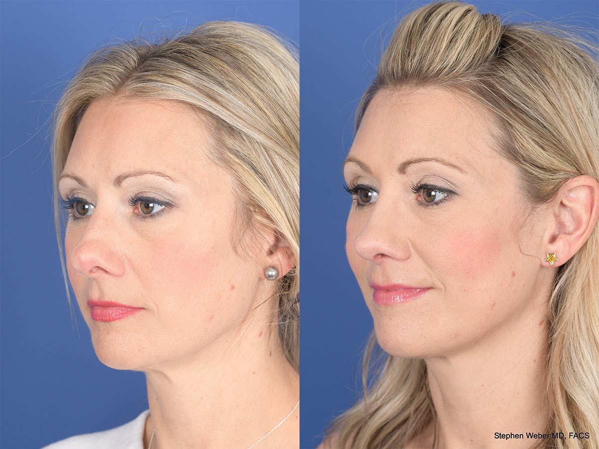 Rhinoplasty Before & After Gallery - Patient 320839 - Image 3