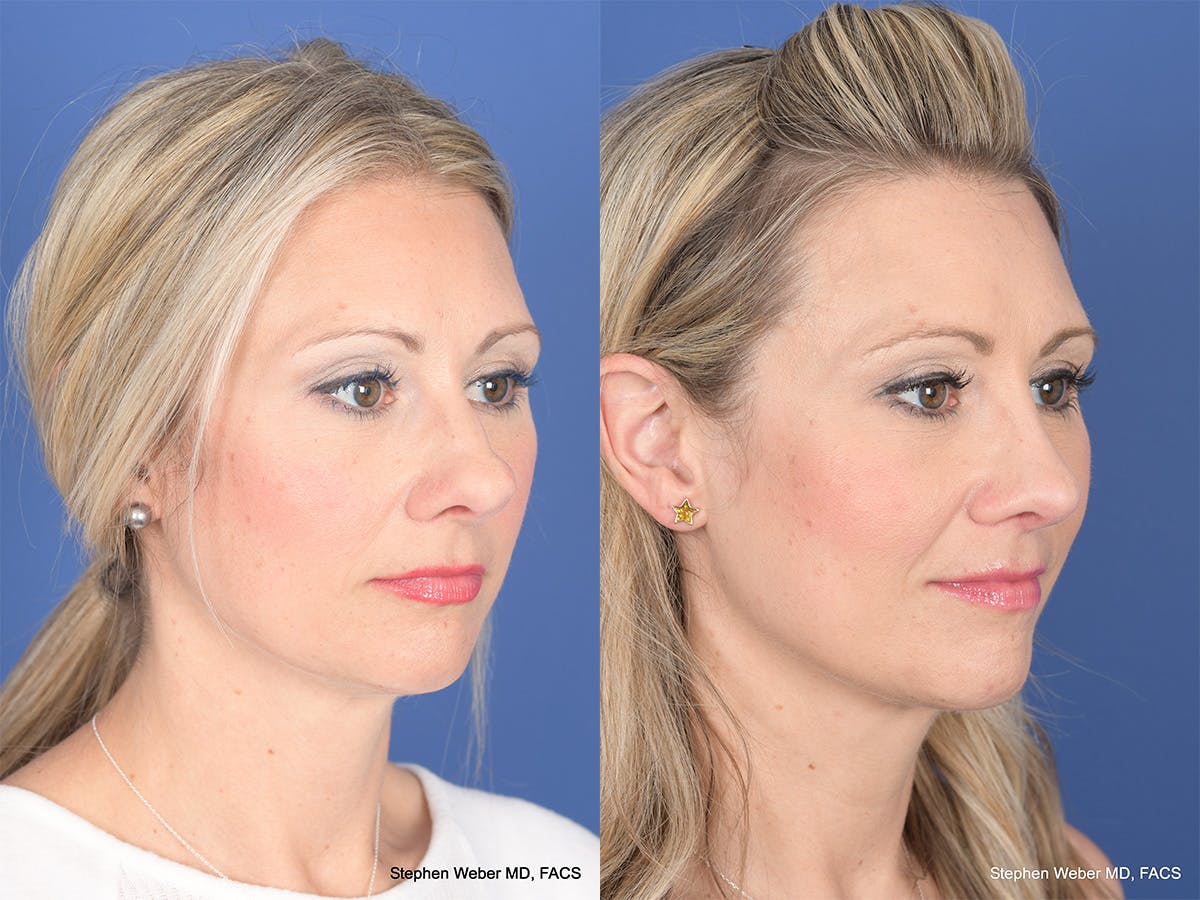 Rhinoplasty Before & After Gallery - Patient 320839 - Image 4