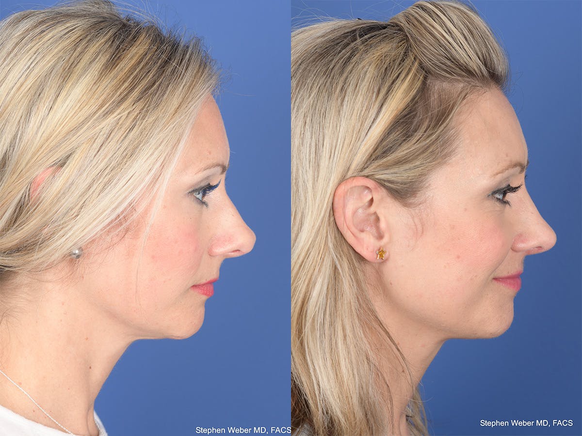 Rhinoplasty Before & After Gallery - Patient 320839 - Image 5