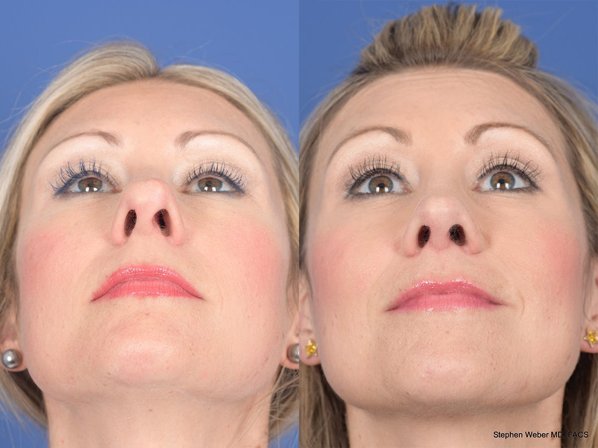 Rhinoplasty Before & After Gallery - Patient 320839 - Image 6