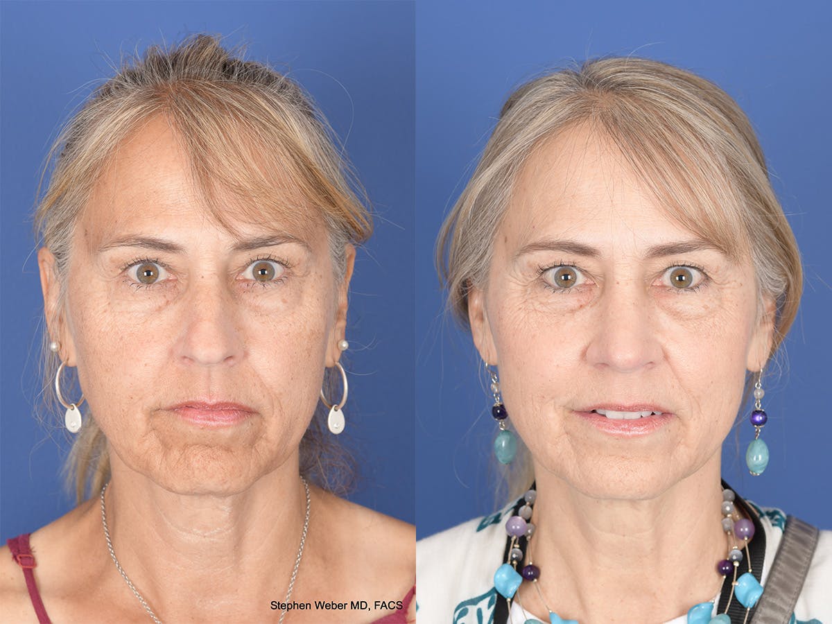 Rhinoplasty Before & After Gallery - Patient 425279 - Image 1