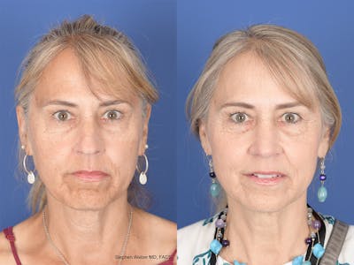 Rhinoplasty Before & After Gallery - Patient 425279 - Image 1