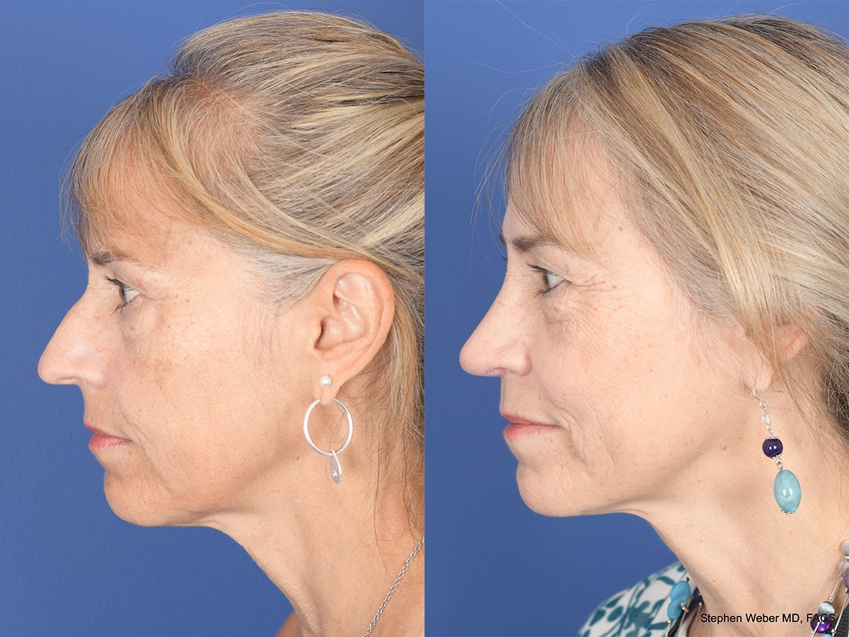 Rhinoplasty Before & After Gallery - Patient 425279 - Image 2