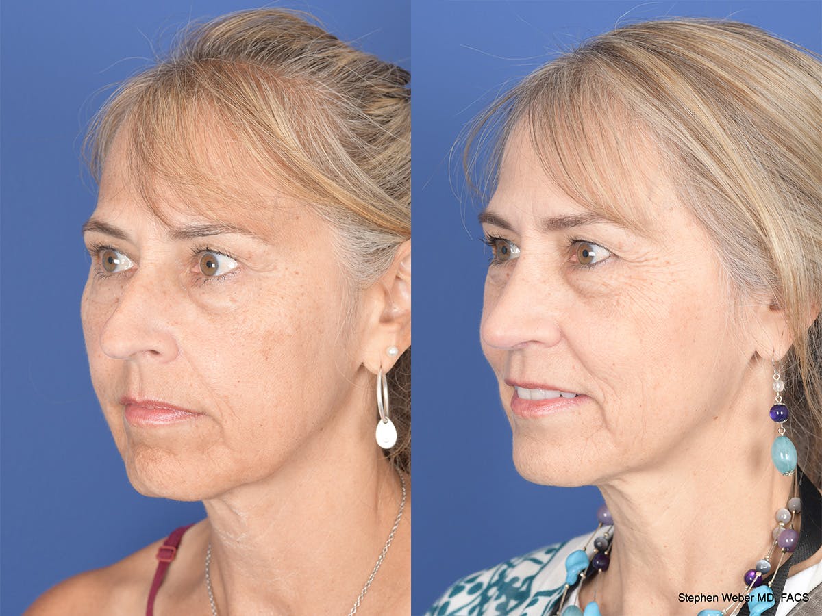 Rhinoplasty Before & After Gallery - Patient 425279 - Image 3