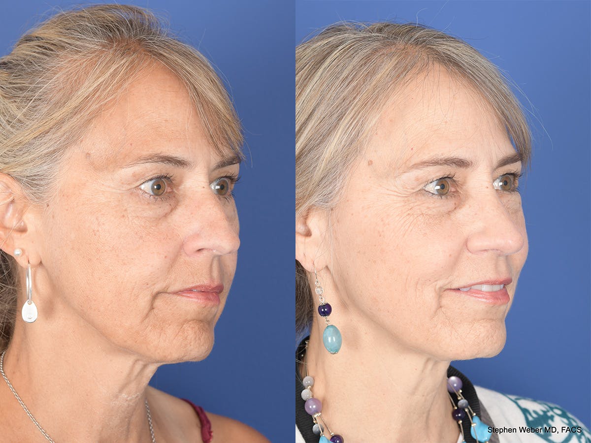 Rhinoplasty Before & After Gallery - Patient 425279 - Image 4