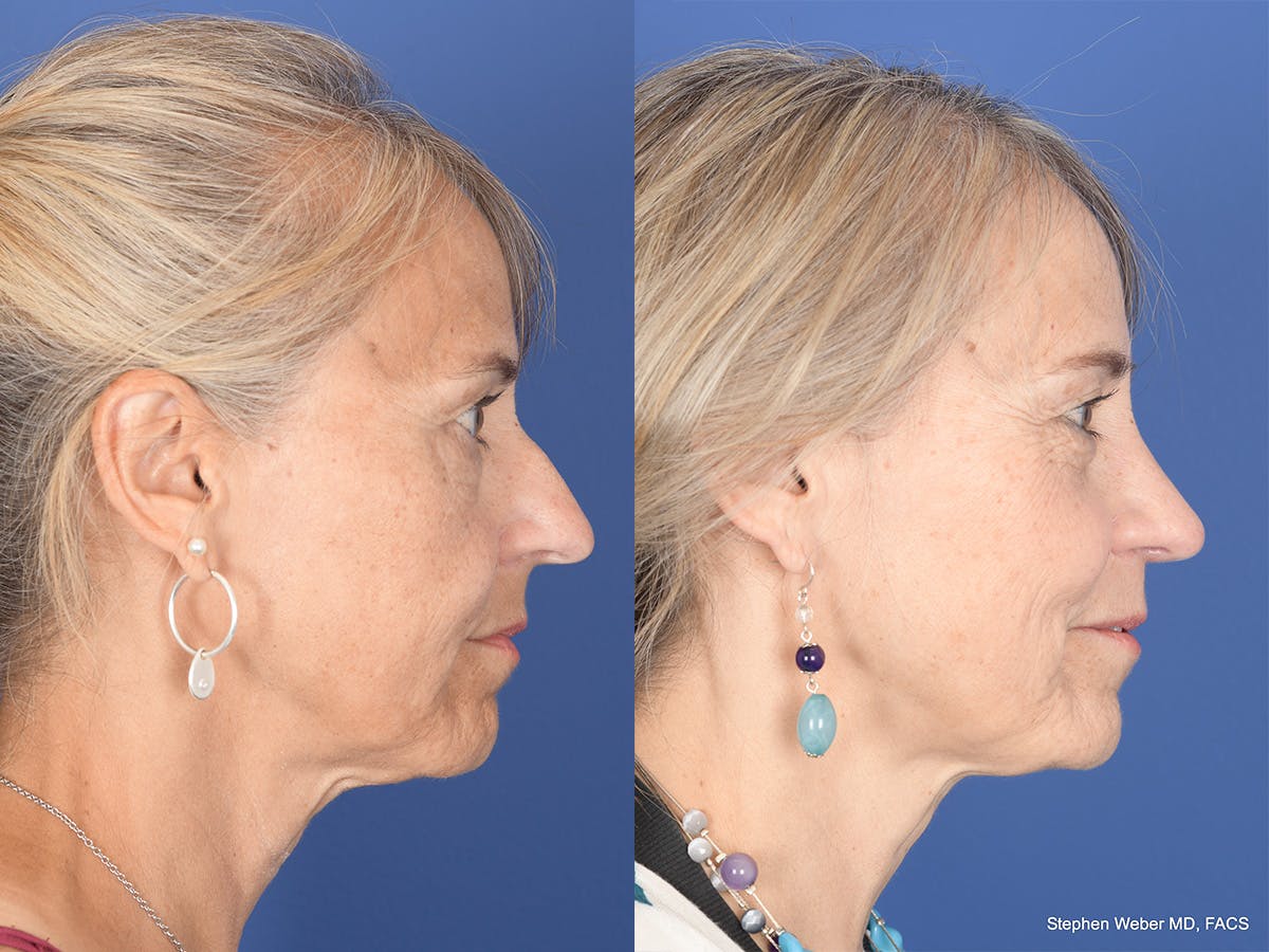 Rhinoplasty Before & After Gallery - Patient 425279 - Image 5