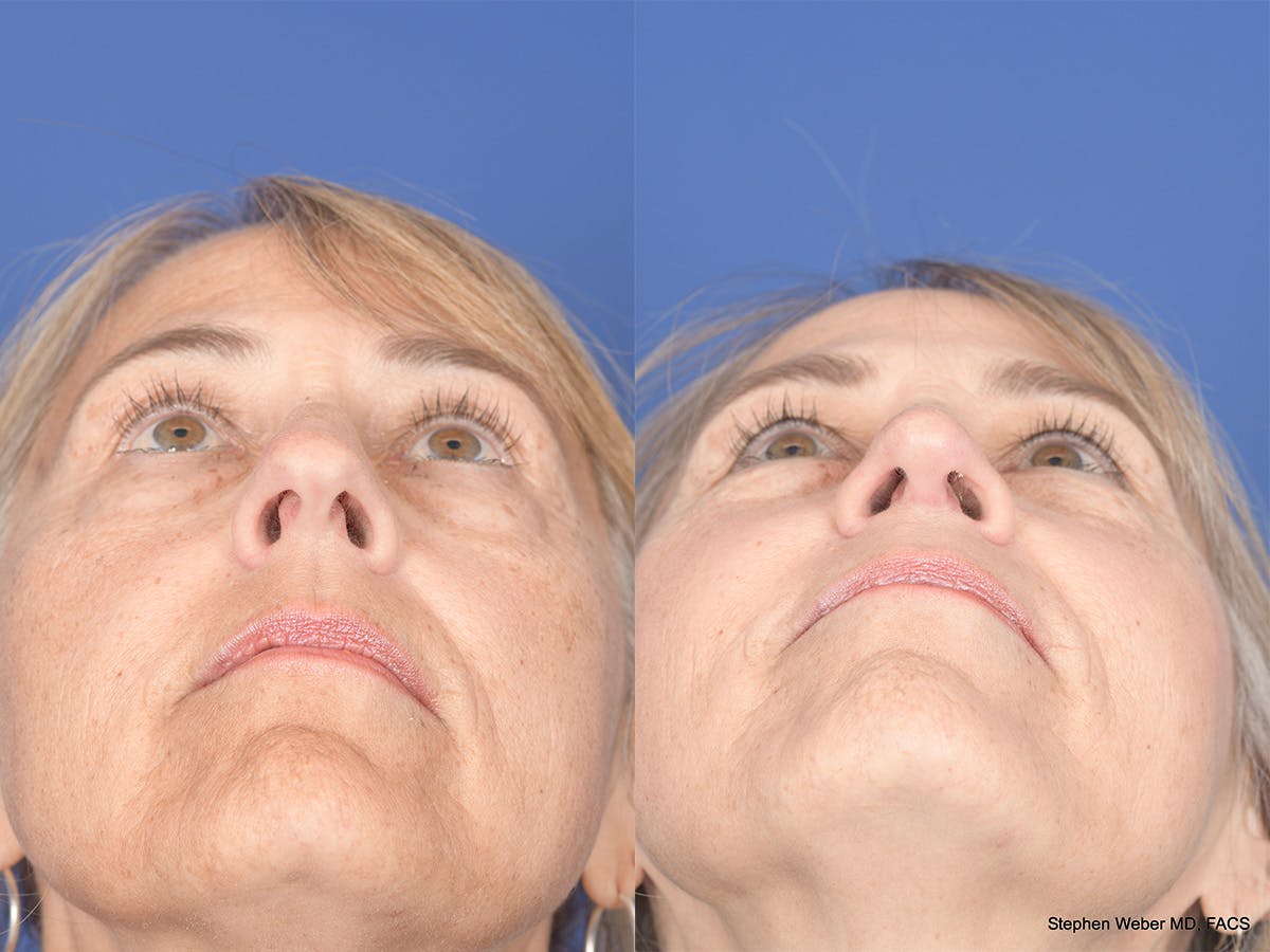 Rhinoplasty Before & After Gallery - Patient 425279 - Image 6