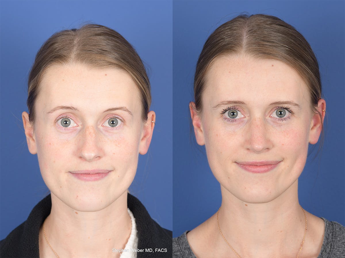 Rhinoplasty Before & After Gallery - Patient 214298 - Image 1