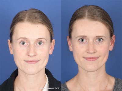 Rhinoplasty Before & After Gallery - Patient 214298 - Image 1