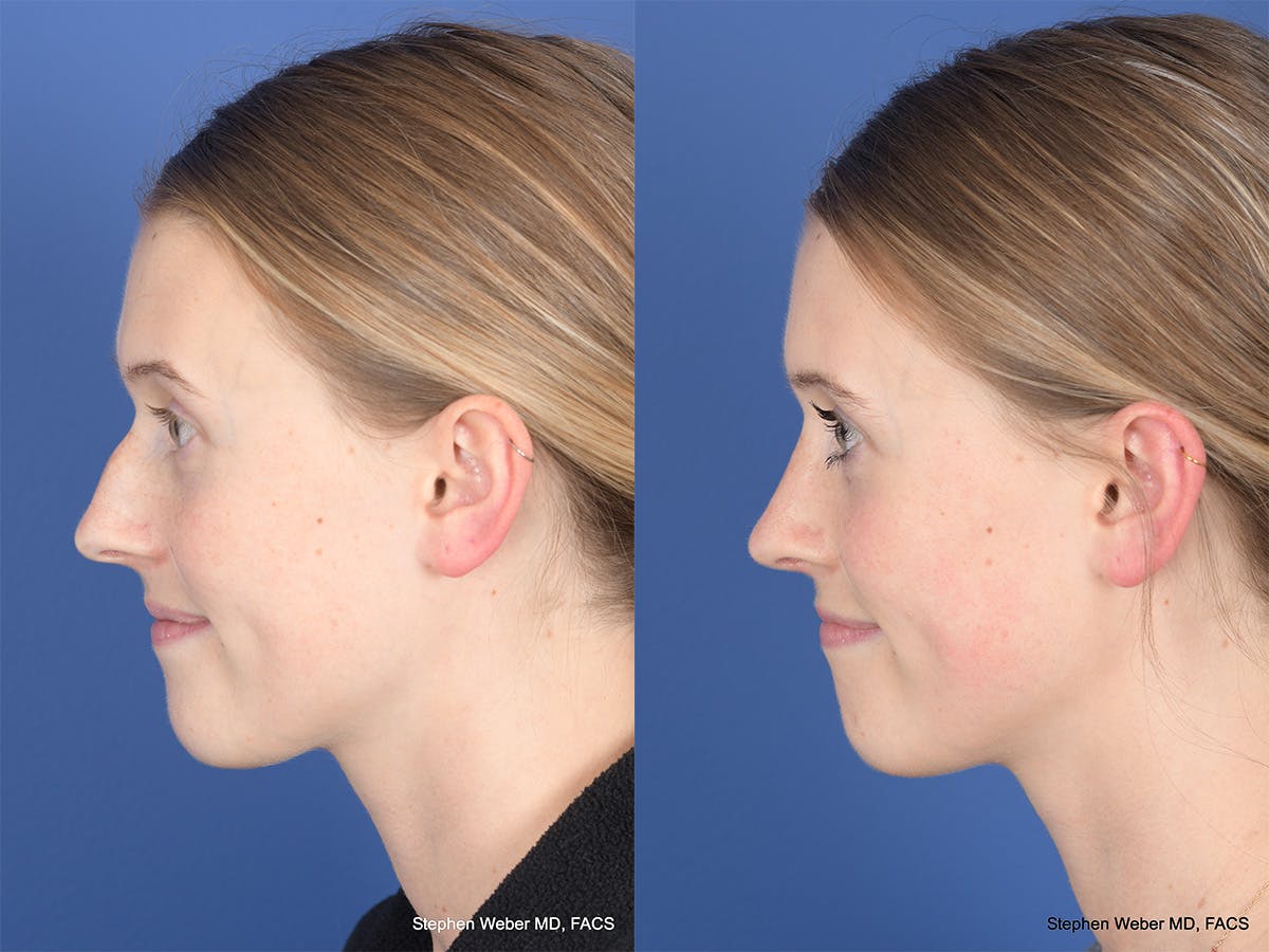 Rhinoplasty Before & After Gallery - Patient 214298 - Image 2