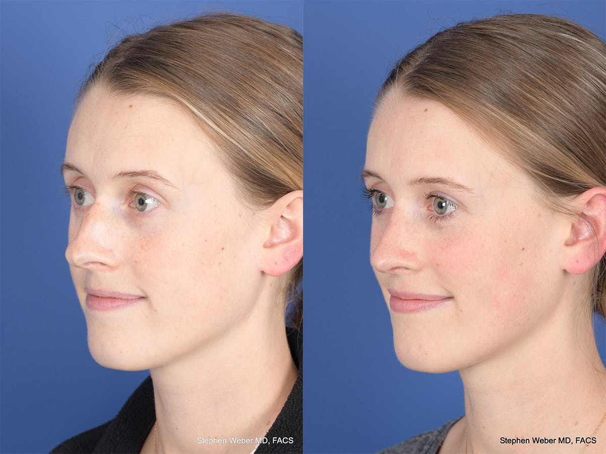 Rhinoplasty Before & After Gallery - Patient 214298 - Image 3