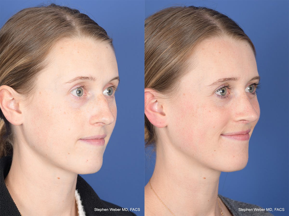 Rhinoplasty Before & After Gallery - Patient 214298 - Image 4