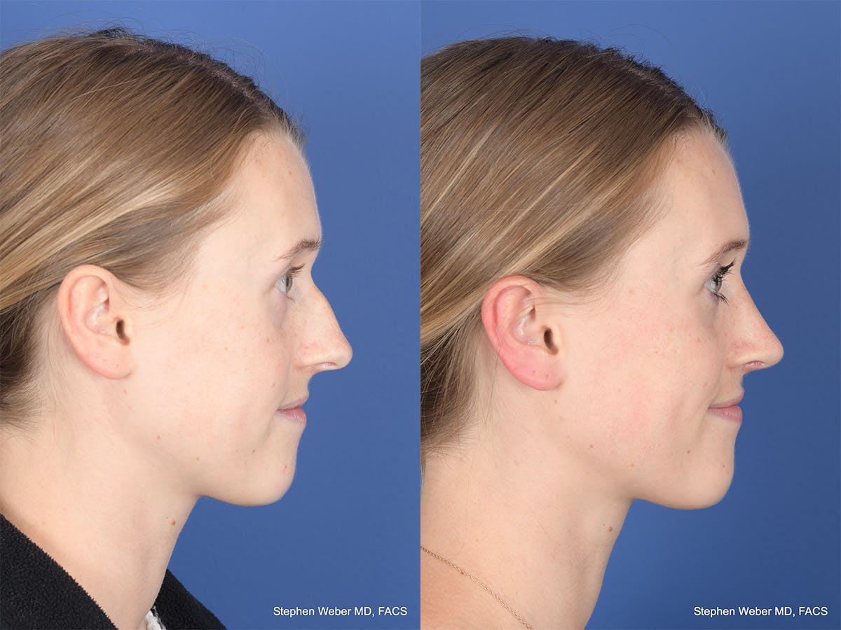 Rhinoplasty Before & After Gallery - Patient 214298 - Image 5