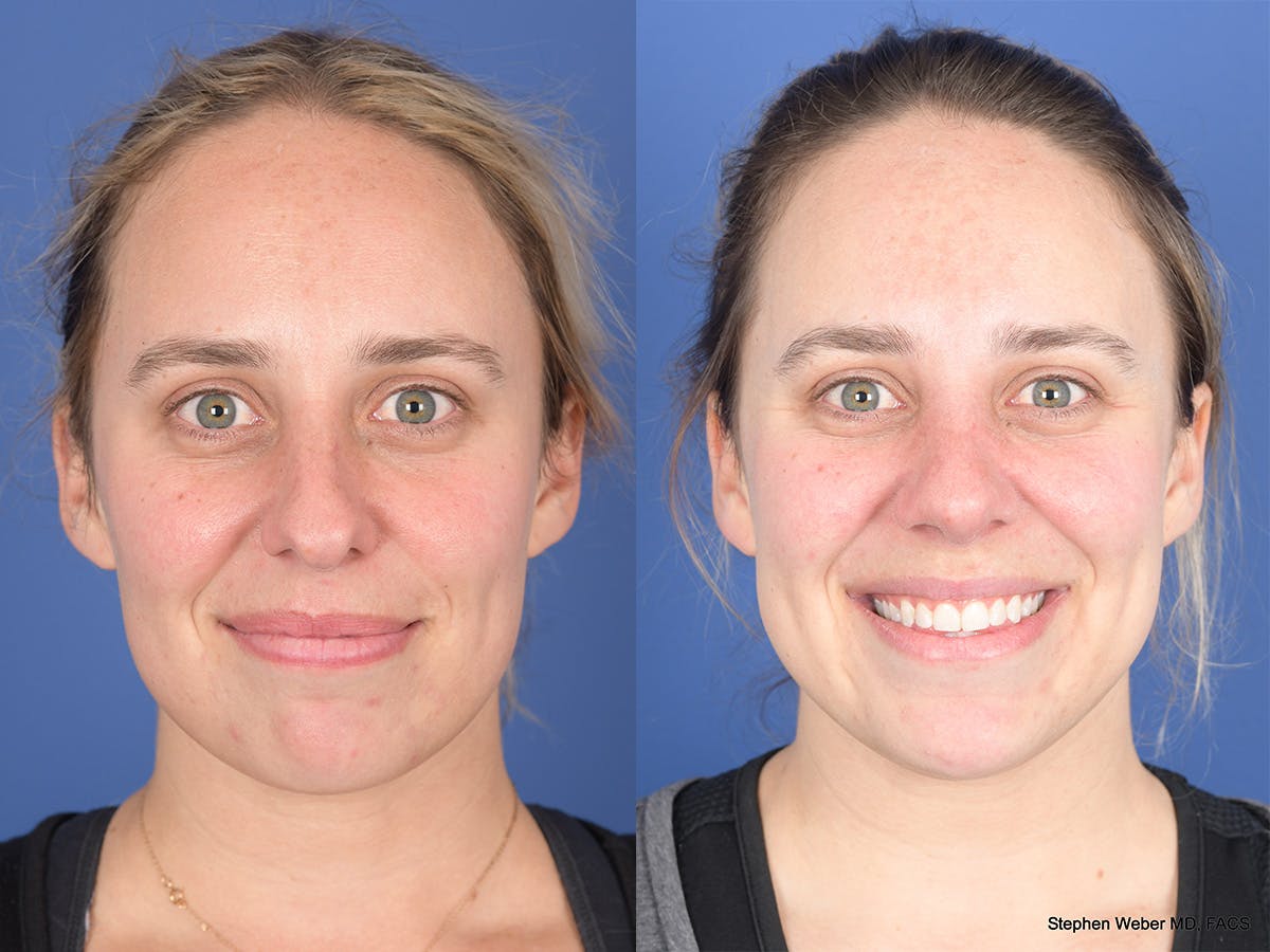 Rhinoplasty Before & After Gallery - Patient 477820 - Image 1