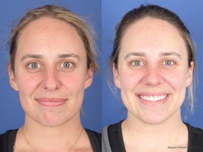 Rhinoplasty Before & After Gallery - Patient 477820 - Image 1