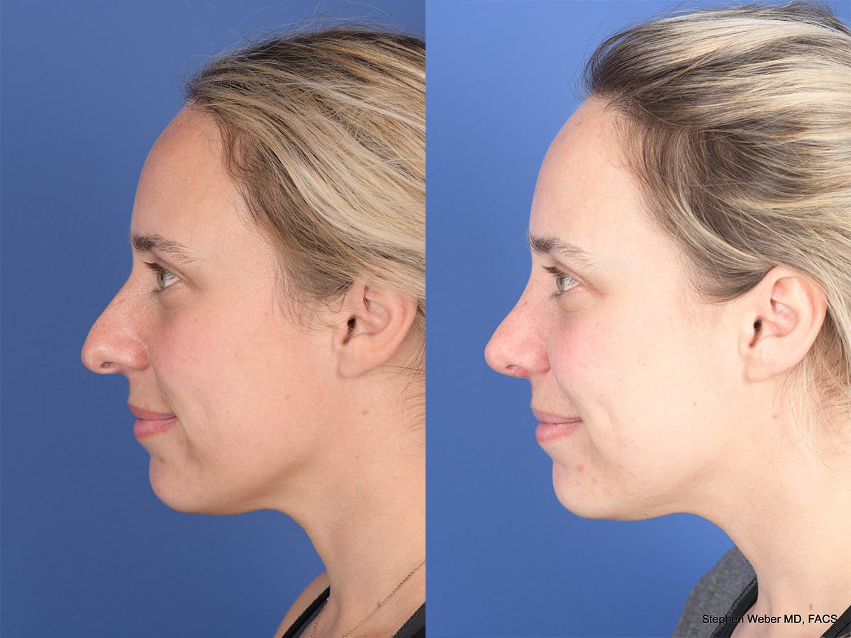 Rhinoplasty Before & After Gallery - Patient 477820 - Image 2
