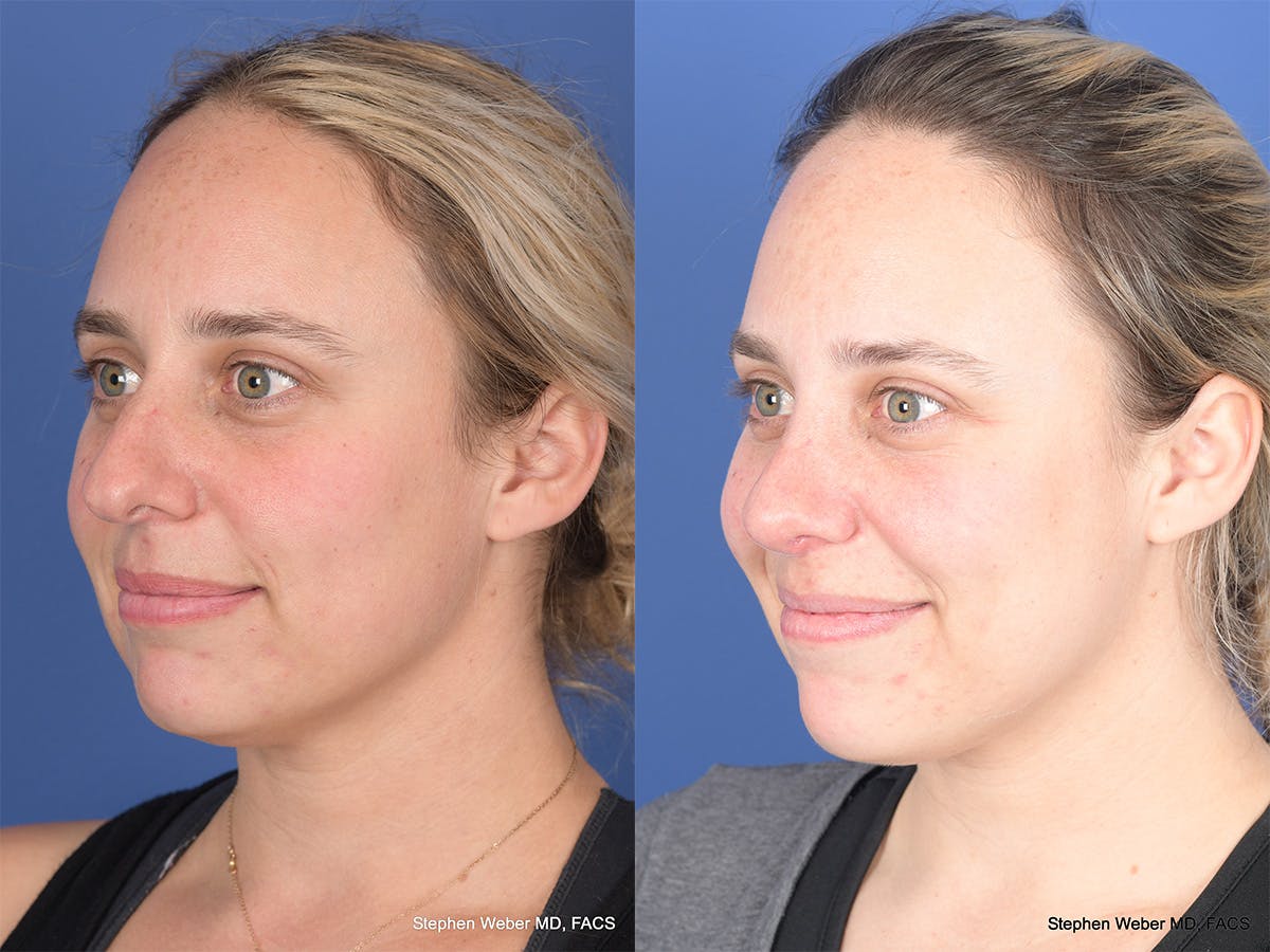 Rhinoplasty Before & After Gallery - Patient 477820 - Image 3