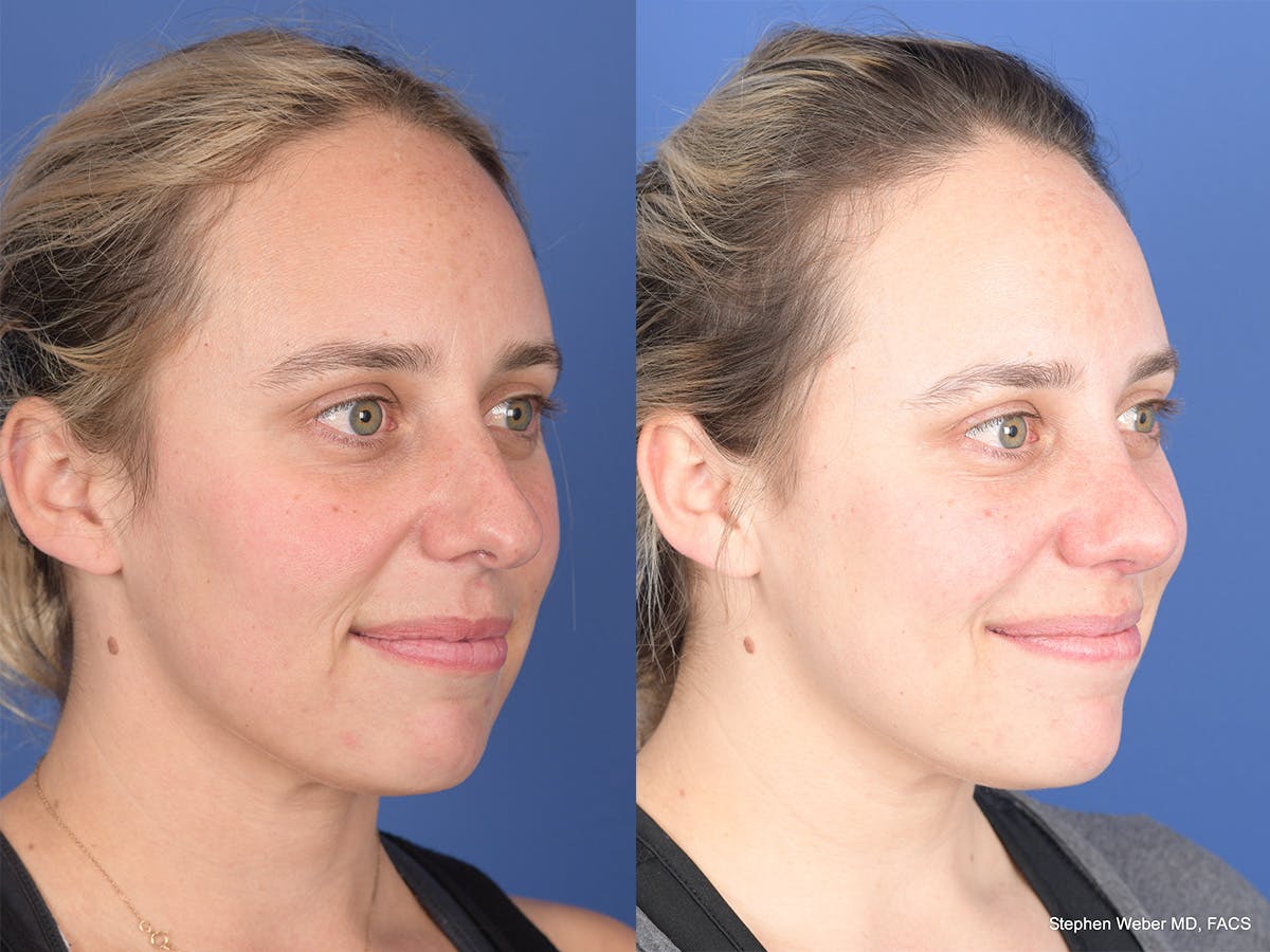 Rhinoplasty Before & After Gallery - Patient 477820 - Image 4