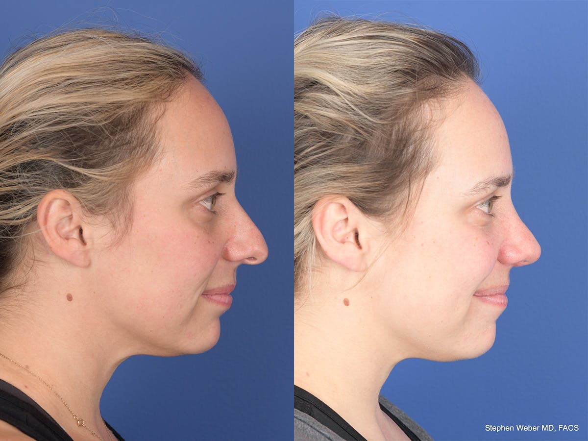 Rhinoplasty Before & After Gallery - Patient 477820 - Image 5