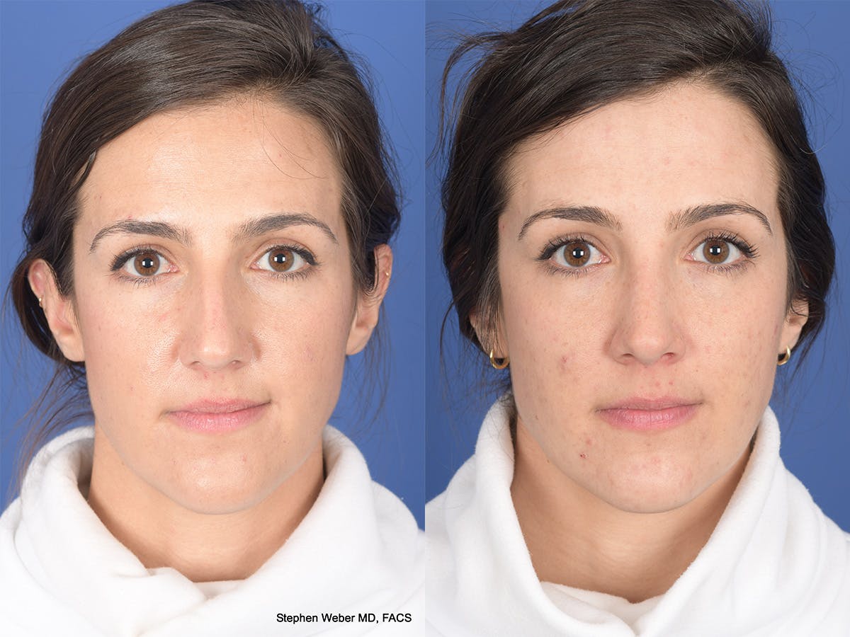 Rhinoplasty Before & After Gallery - Patient 283759 - Image 1