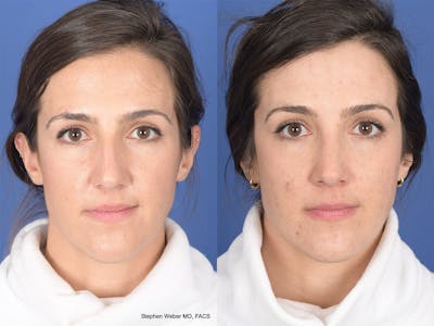 Rhinoplasty Before & After Gallery - Patient 283759 - Image 1