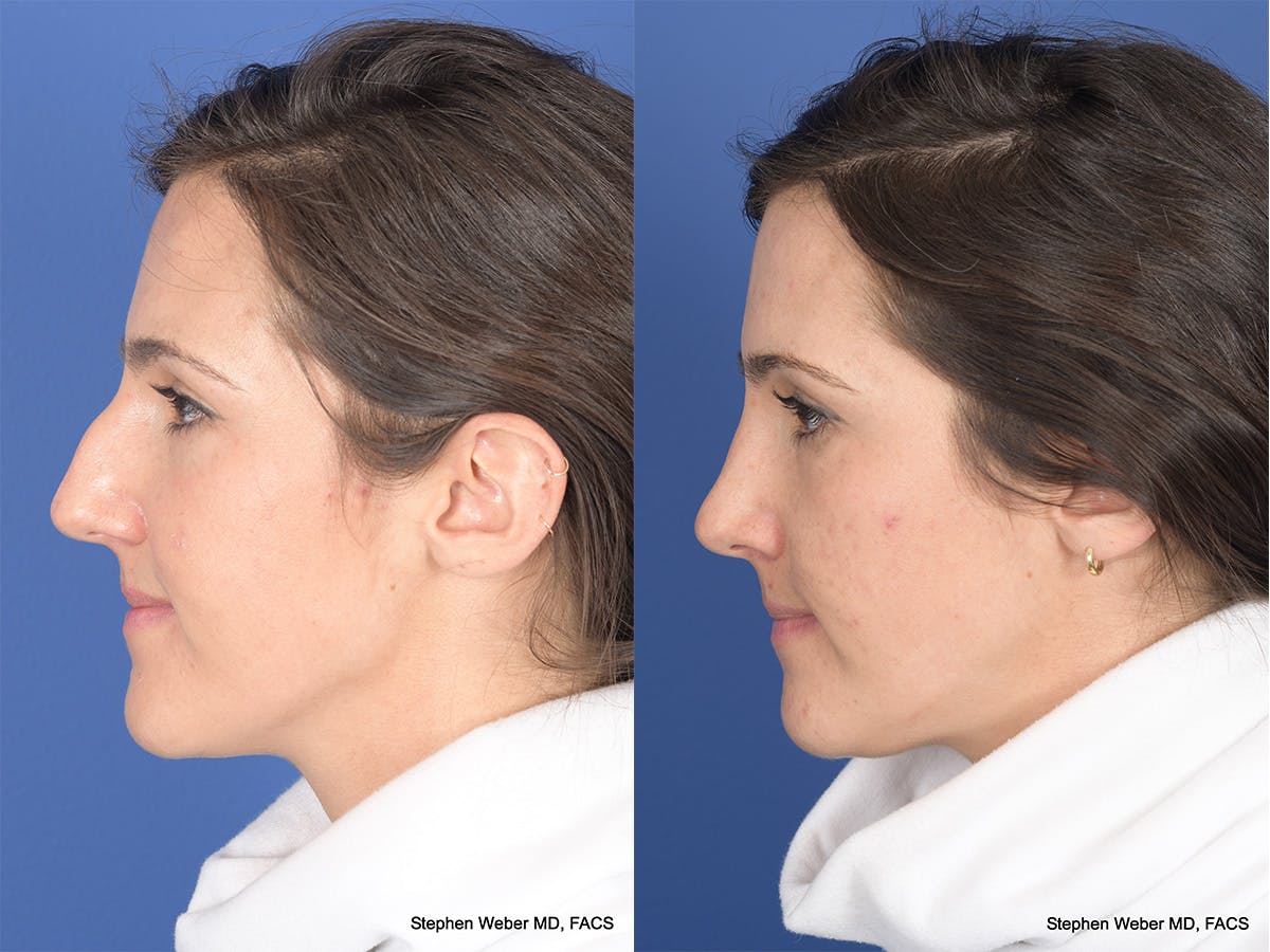 Rhinoplasty Before & After Gallery - Patient 283759 - Image 2