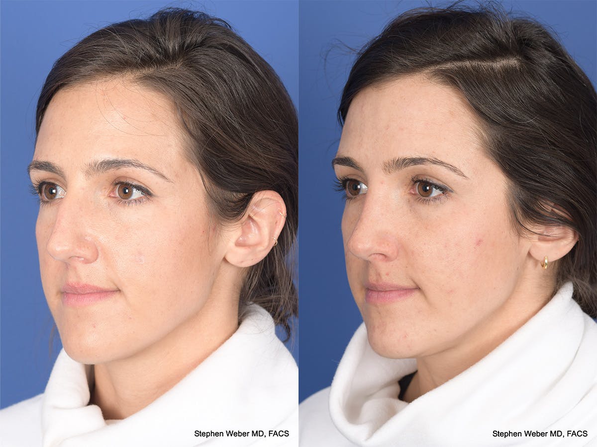 Rhinoplasty Before & After Gallery - Patient 283759 - Image 3