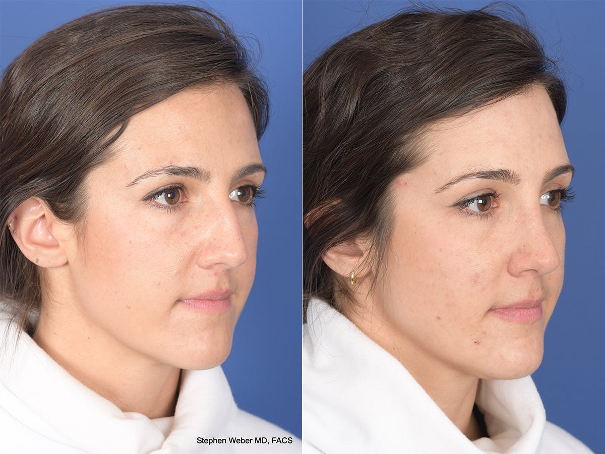Rhinoplasty Before & After Gallery - Patient 283759 - Image 4
